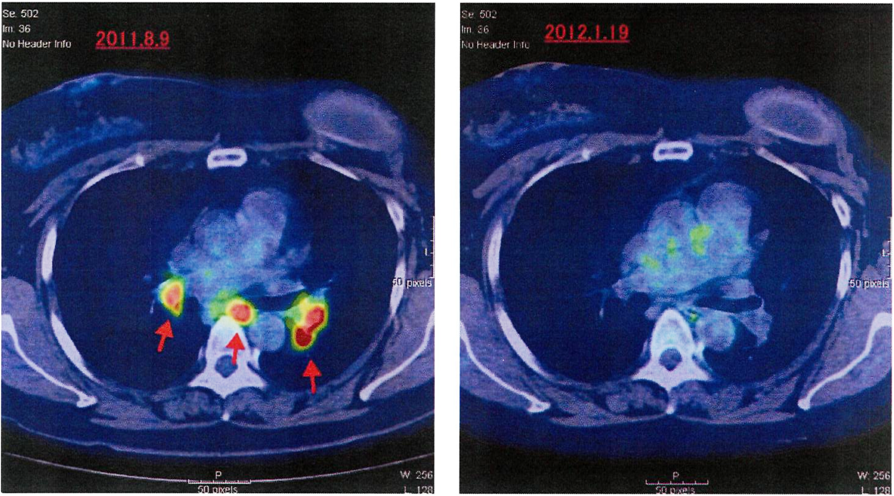 乳癌の経過PET-CTPGb